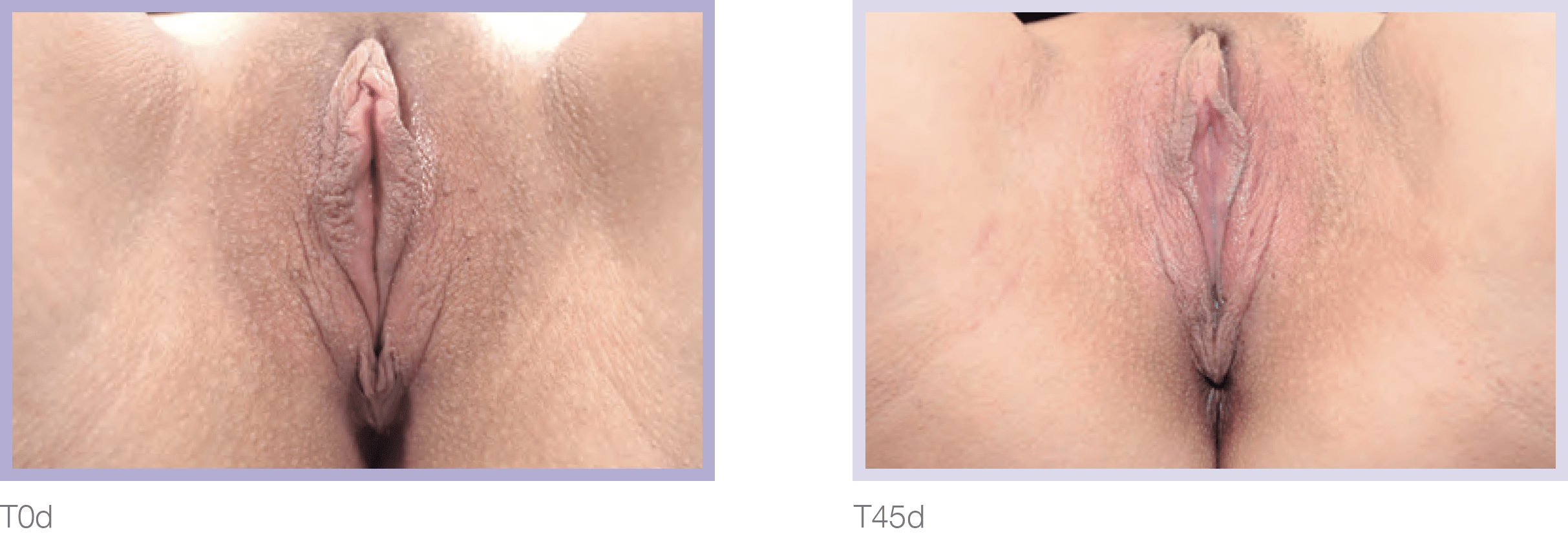 Dermamelan Intimate Before & After in Pikesville & Baltimore 00002