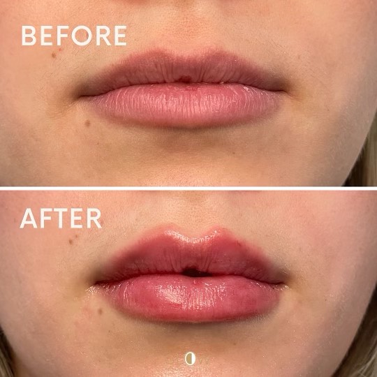 Lip Filler in Pikesville and Baltimore