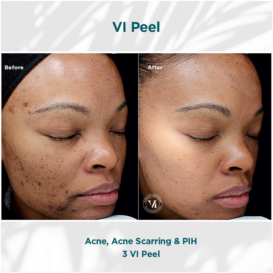 Vi Peel Treatment Before & After In Pikesville and Baltimore Maryland 00004