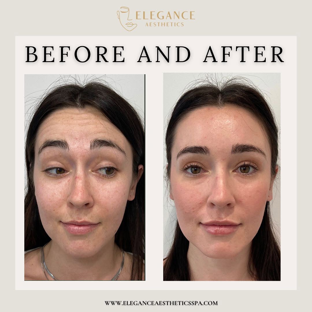 Dysport-Treatment-in-Baltimore-MD-2