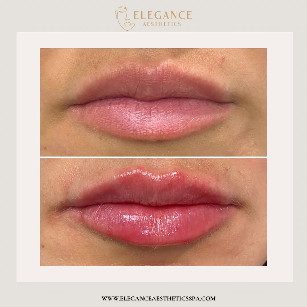 Lip-Filler-in-Baltimore-MD-2