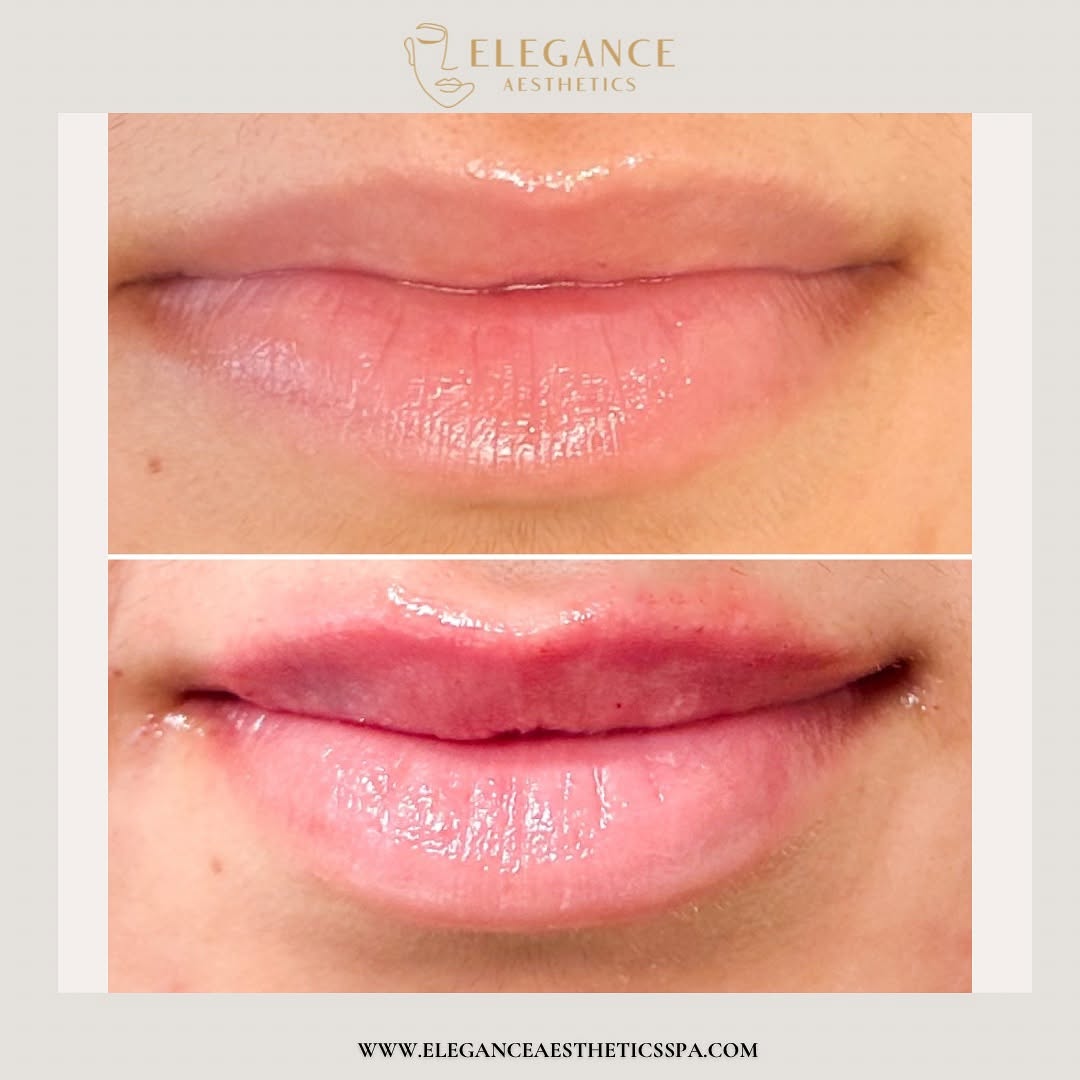 Lip-Filler-in-Baltimore-MD-3
