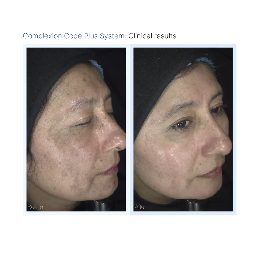 Complexion Code Plus Before & After Pikesville & Baltimore 00003