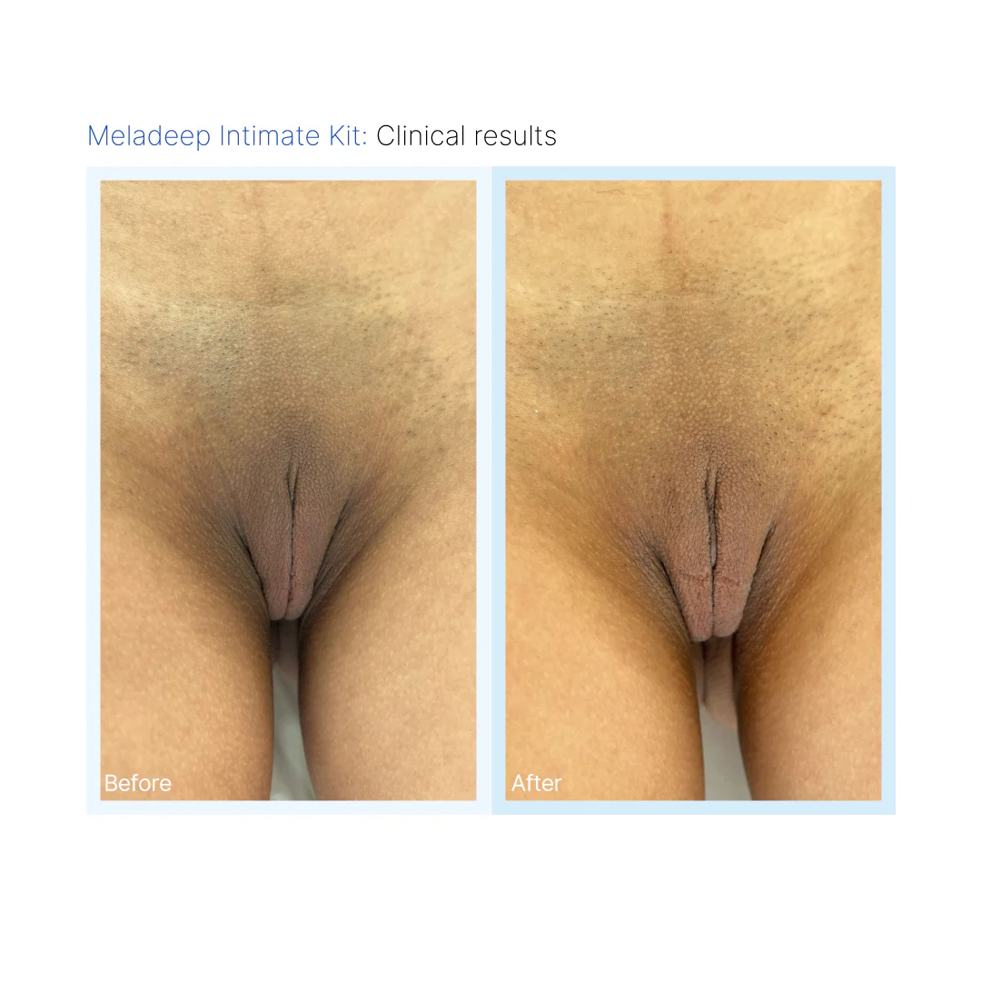 Meladeep Intimate Skin Discoloration Before & After