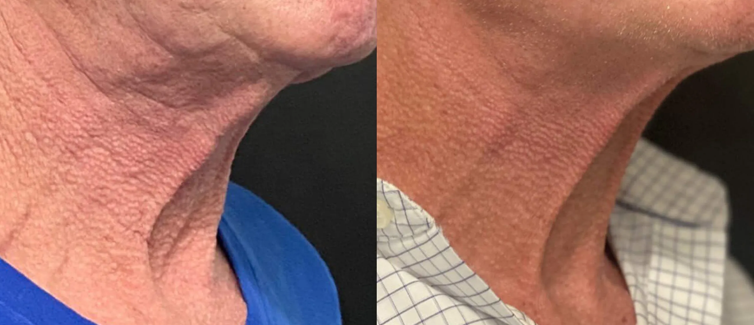 Morpheus8 Before and After Treatment in Baltimore 10