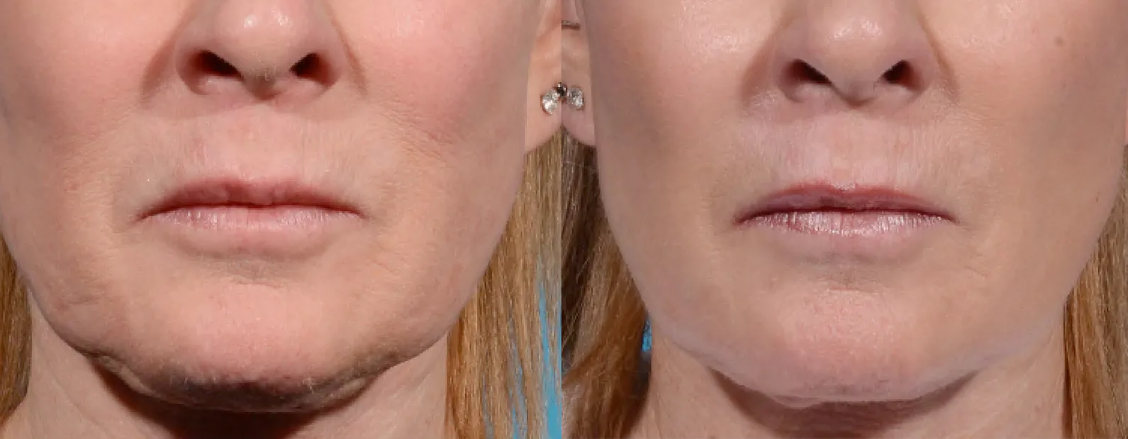 Morpheus8 Before and After Treatment in Baltimore 11