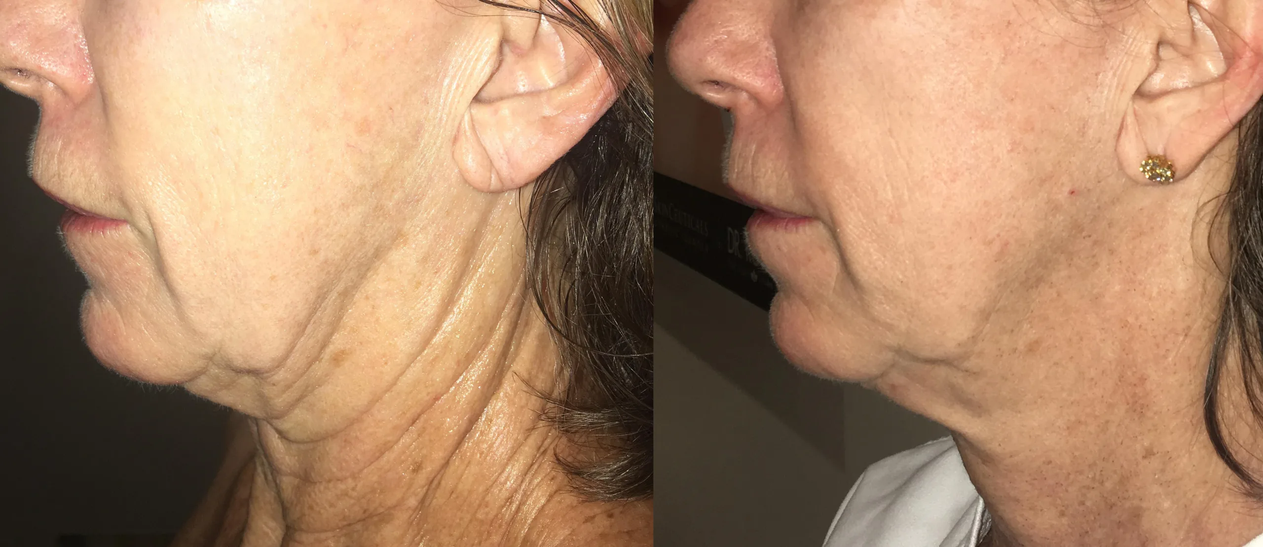 Morpheus8 Before and After Treatment in Baltimore 12