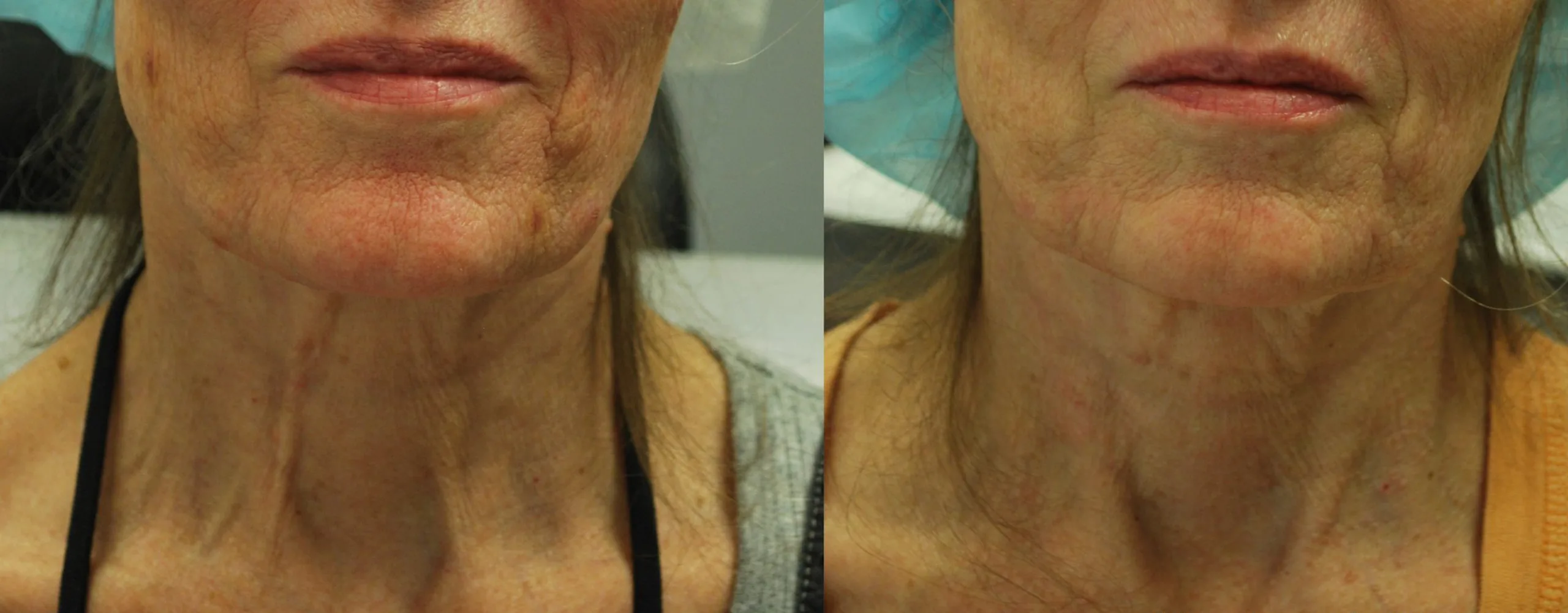 Morpheus8 Before and After Treatment in Baltimore 13