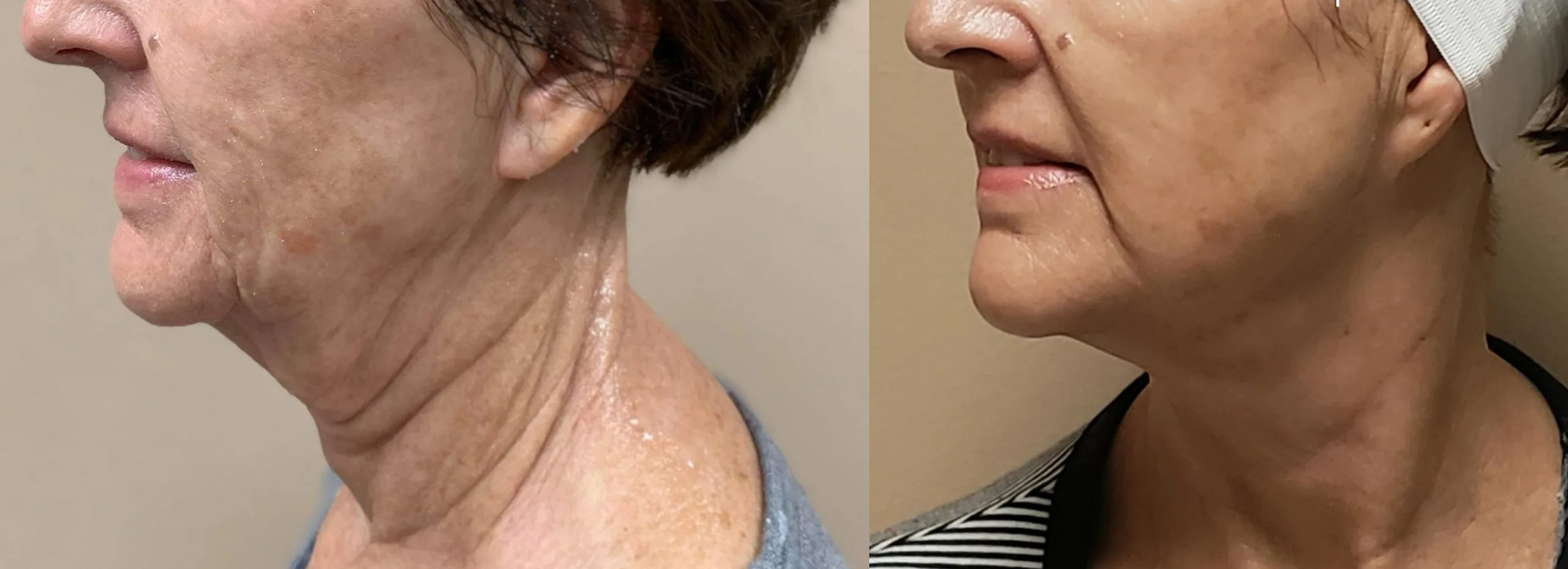 Morpheus8 Before and After Treatment in Baltimore 14