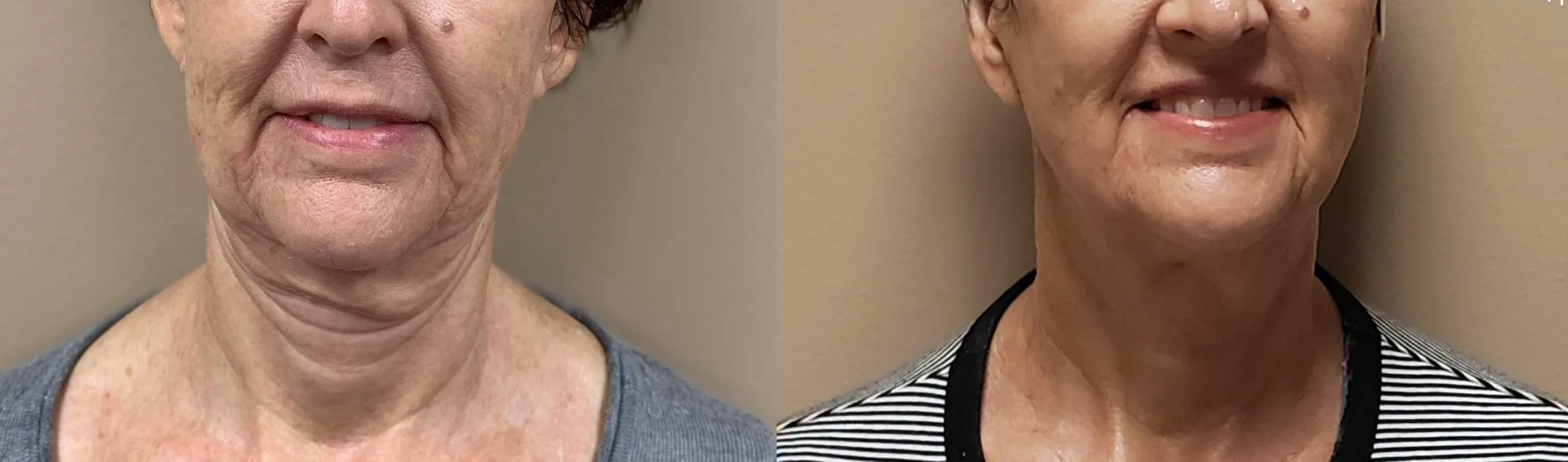 Morpheus8 Before and After Treatment in Baltimore 15