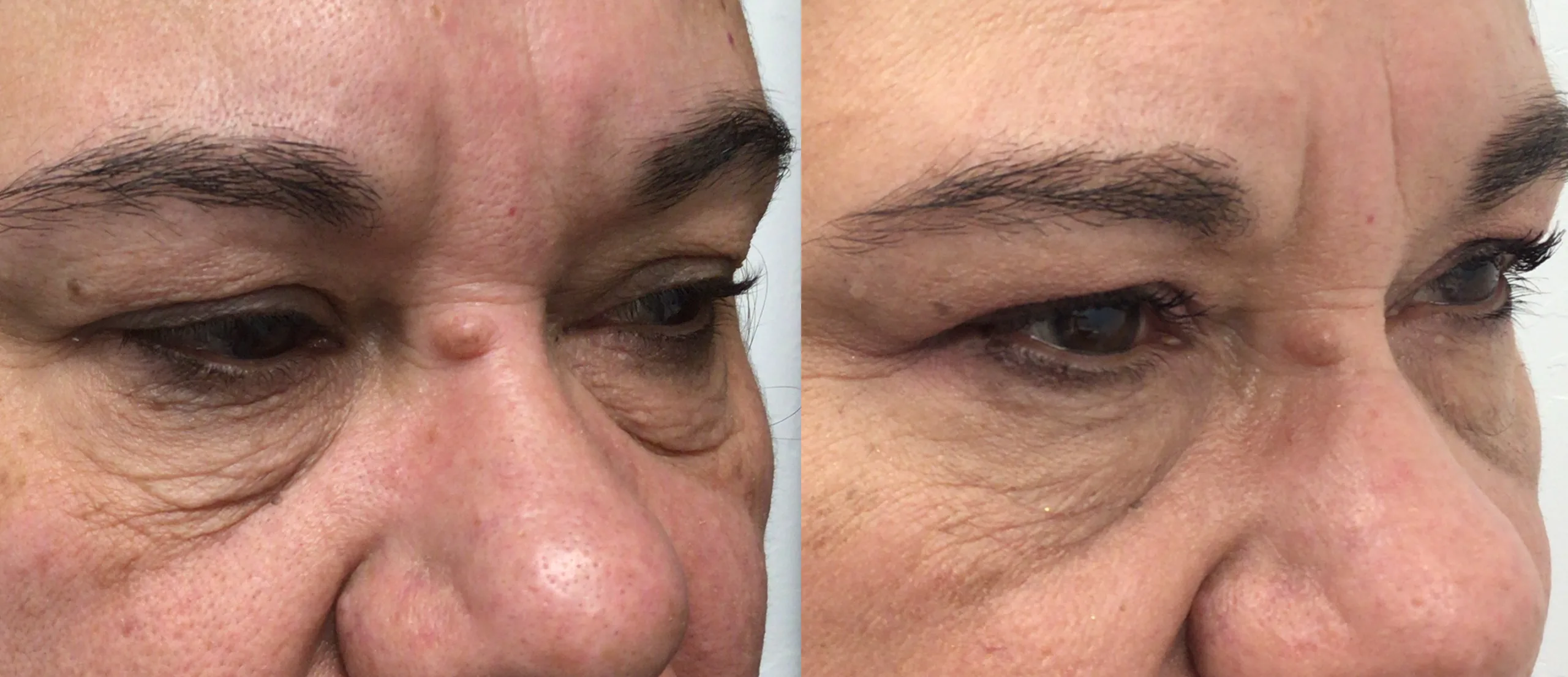 Morpheus8 Before and After Treatment in Baltimore 17