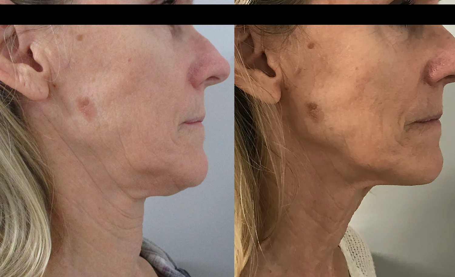 Morpheus8 Before and After Treatment in Baltimore 19