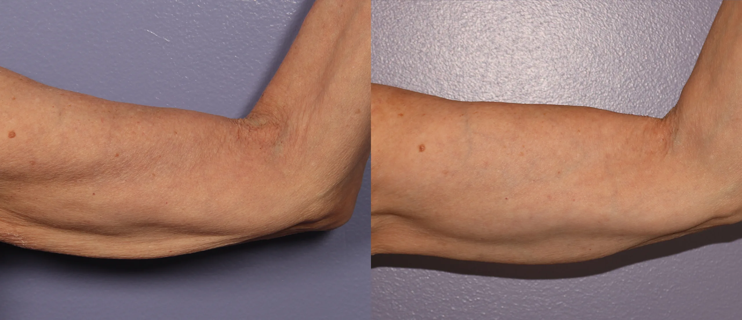 Morpheus8 Before and After Treatment in Baltimore 2