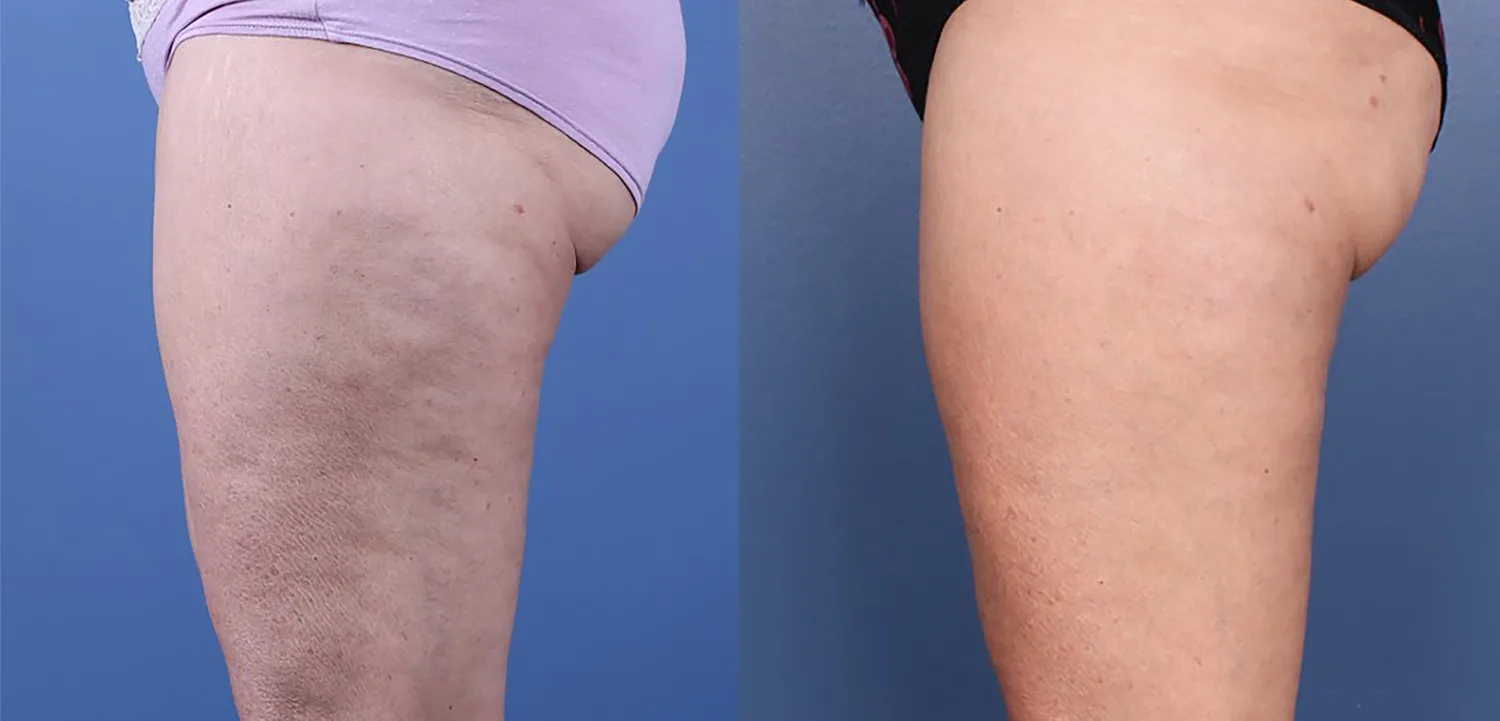 Morpheus8 Before and After Treatment in Baltimore 20