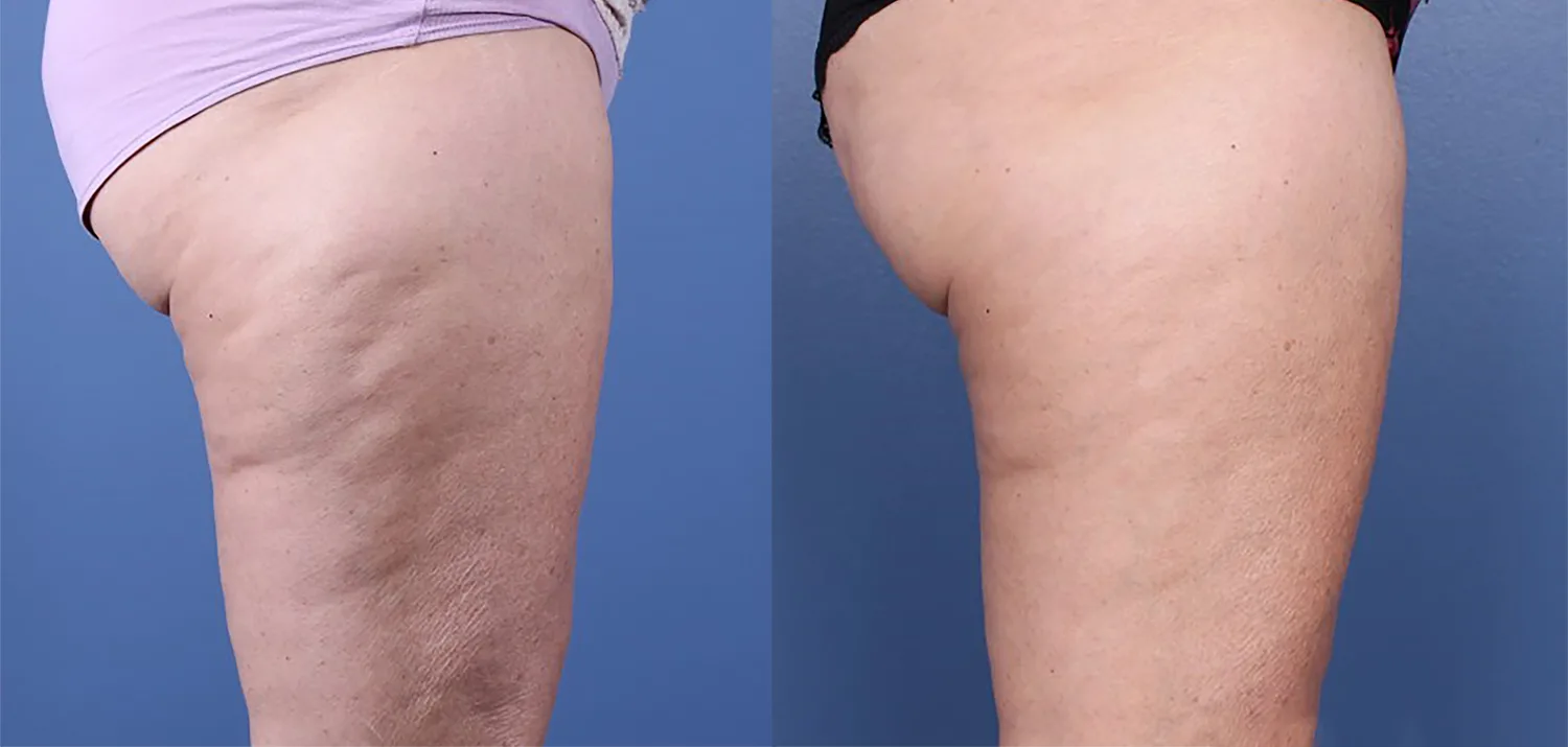 Morpheus8 Before and After Treatment in Baltimore 21