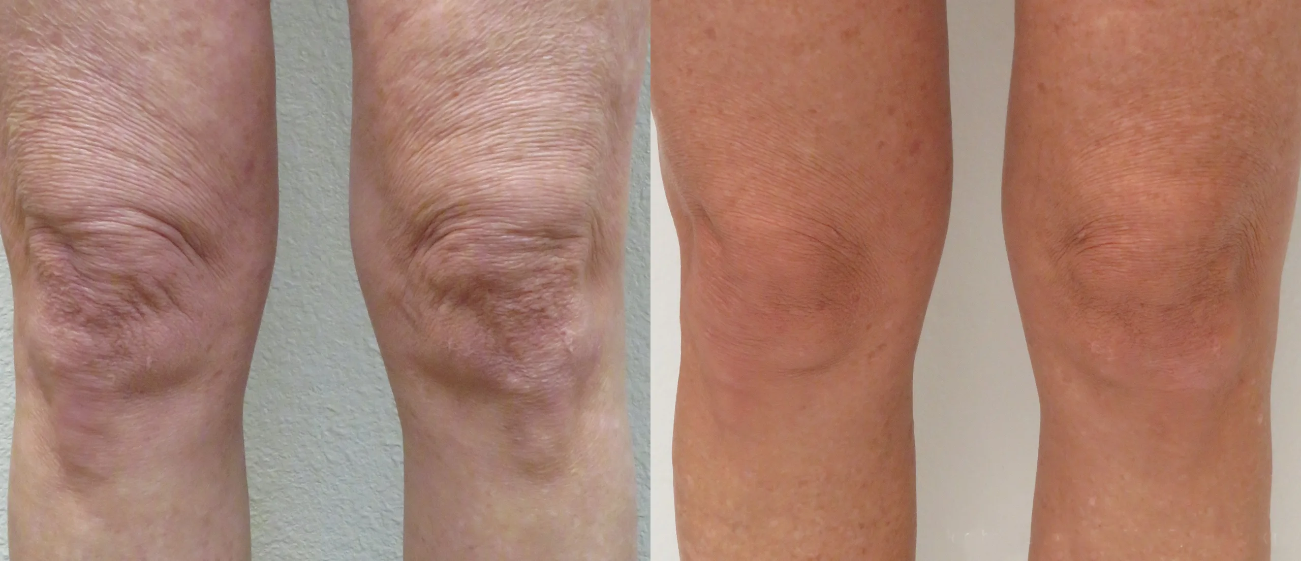 Morpheus8 Before and After Treatment in Baltimore 22