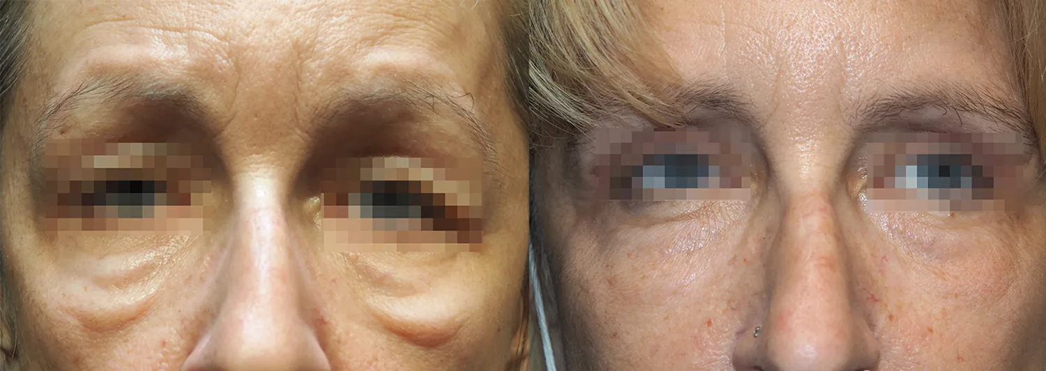 Morpheus8 Before and After Treatment in Baltimore 24