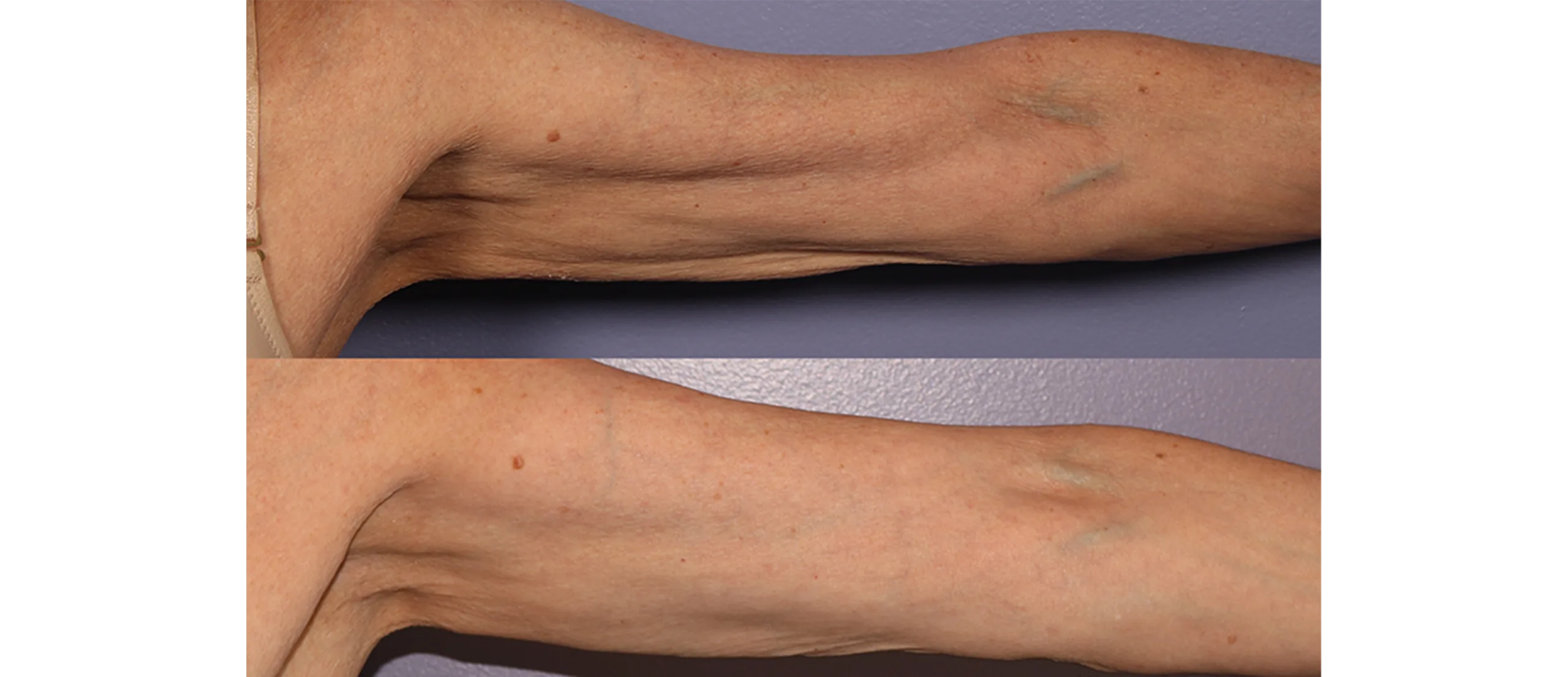 Morpheus8 Before and After Treatment in Baltimore 3