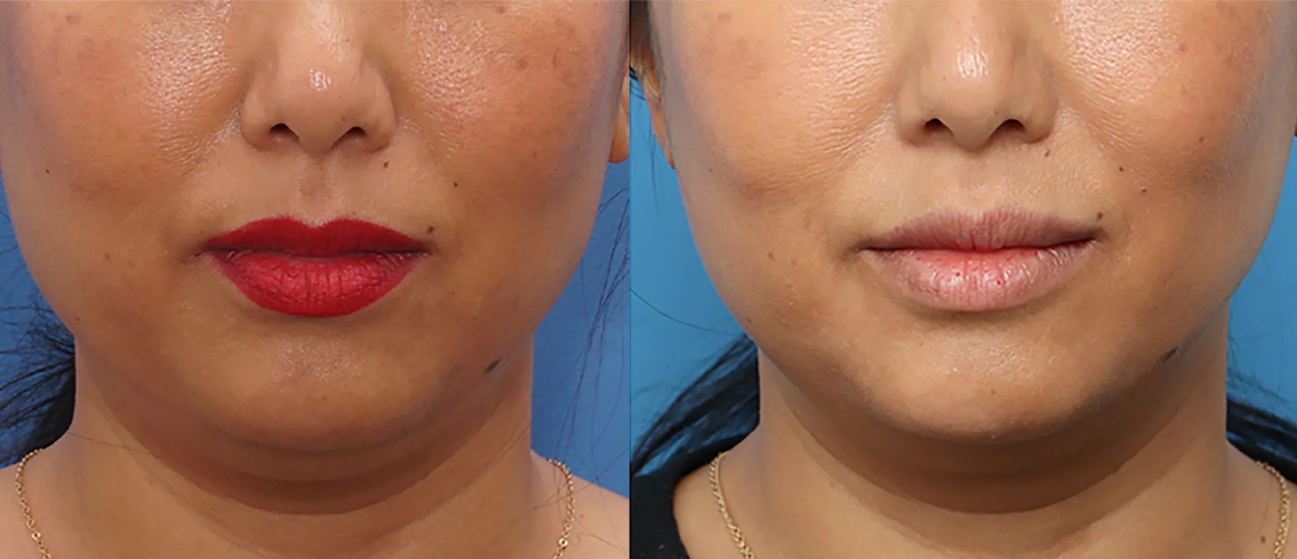 Morpheus8 Before and After Treatment in Baltimore 4