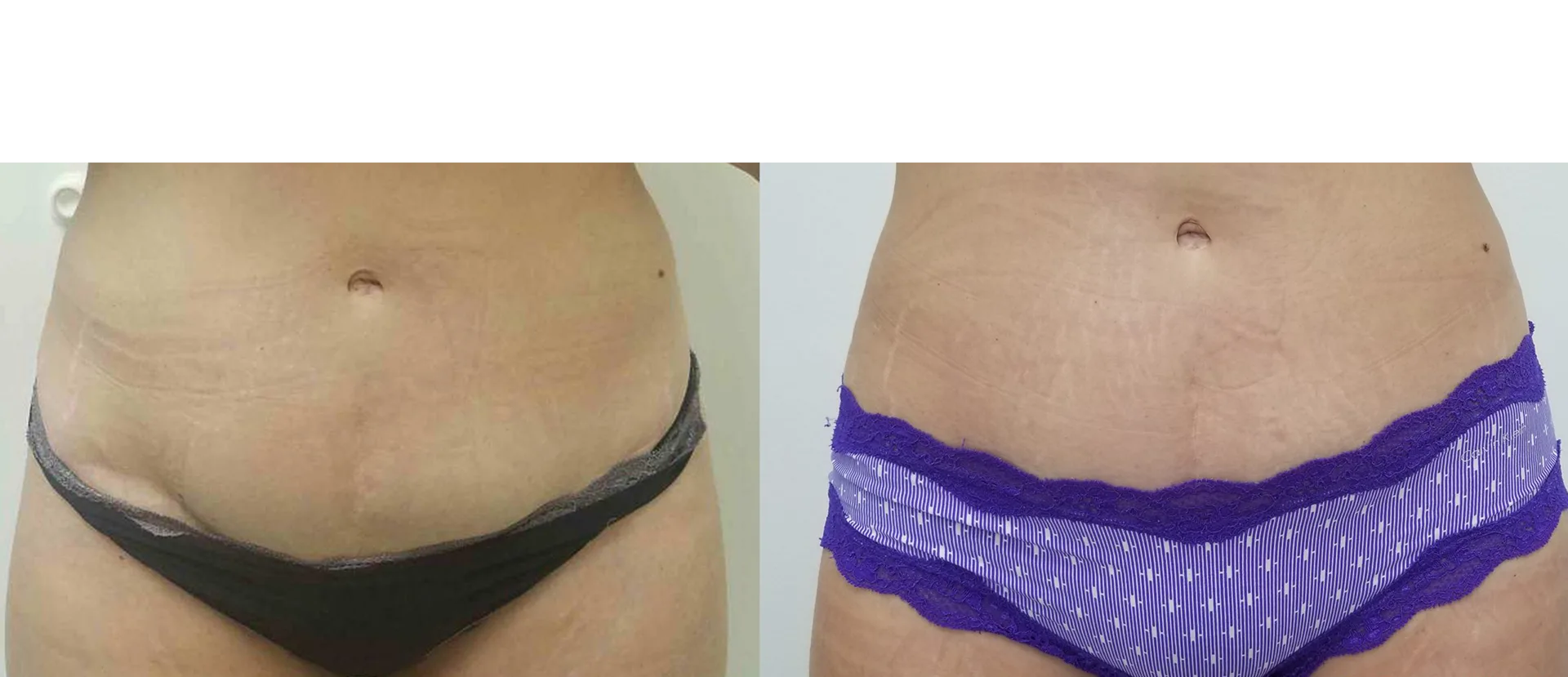 Morpheus8 Before and After Treatment in Baltimore 5