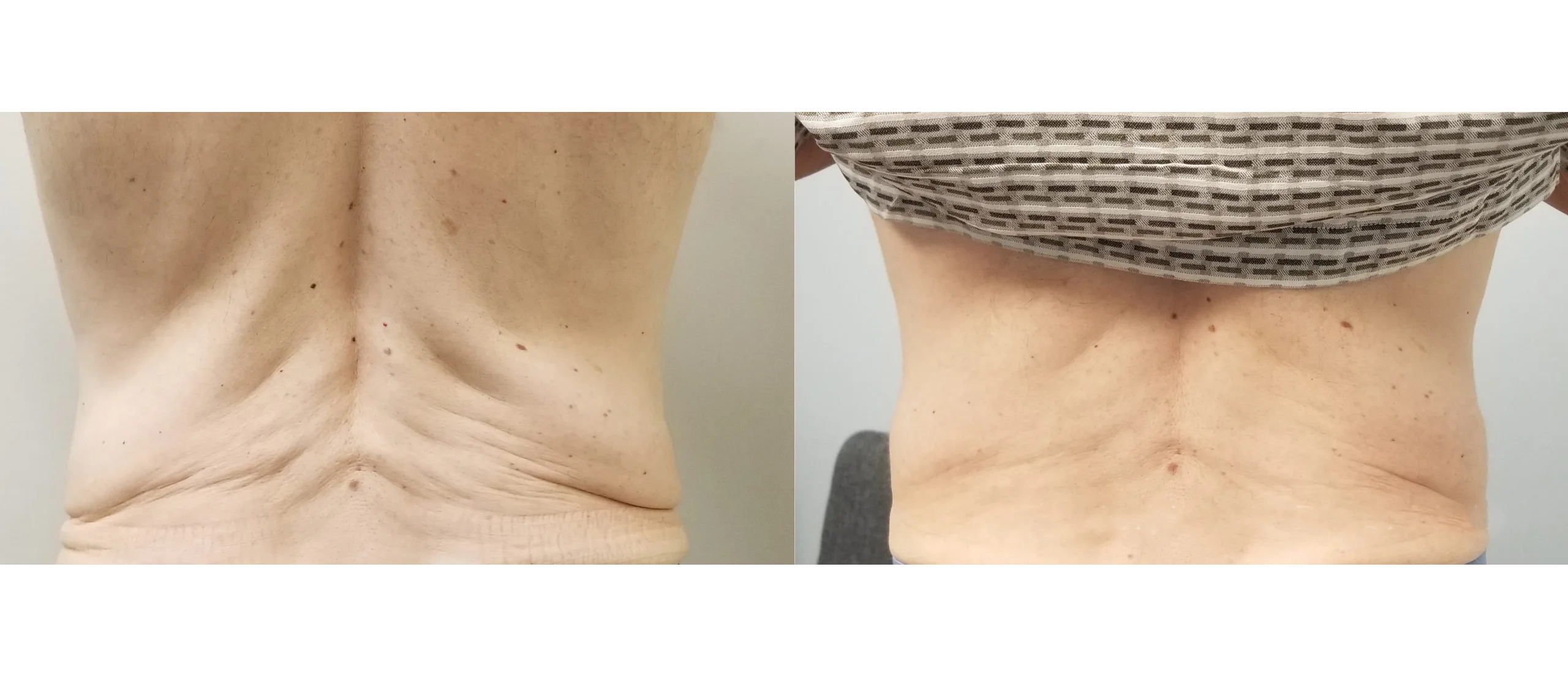 Morpheus8 Before and After Treatment in Baltimore 6