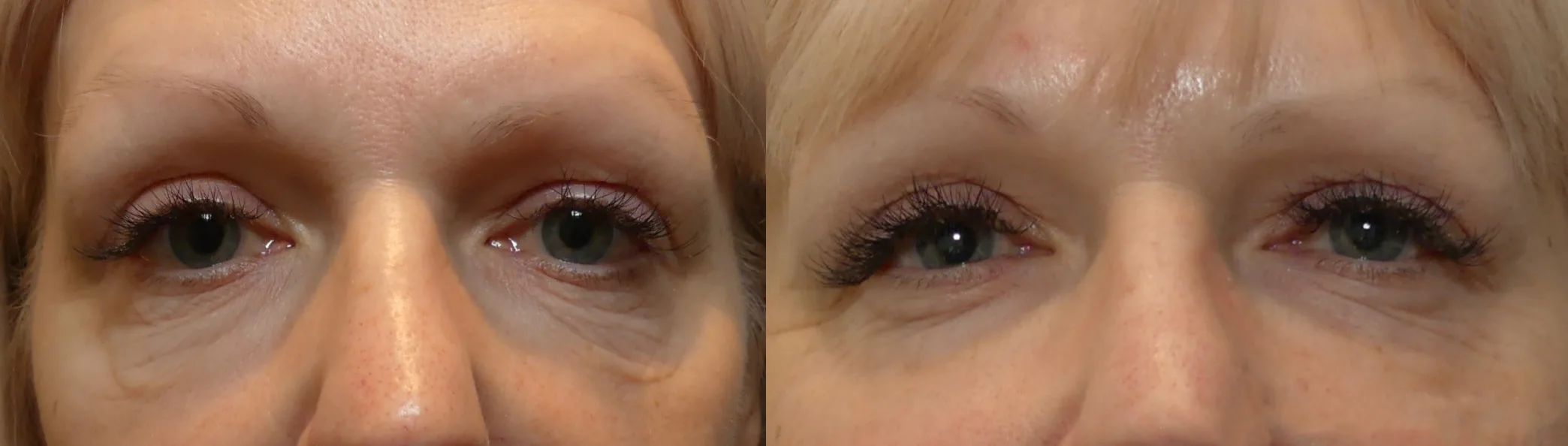 Morpheus8 Before and After Treatment in Baltimore 7