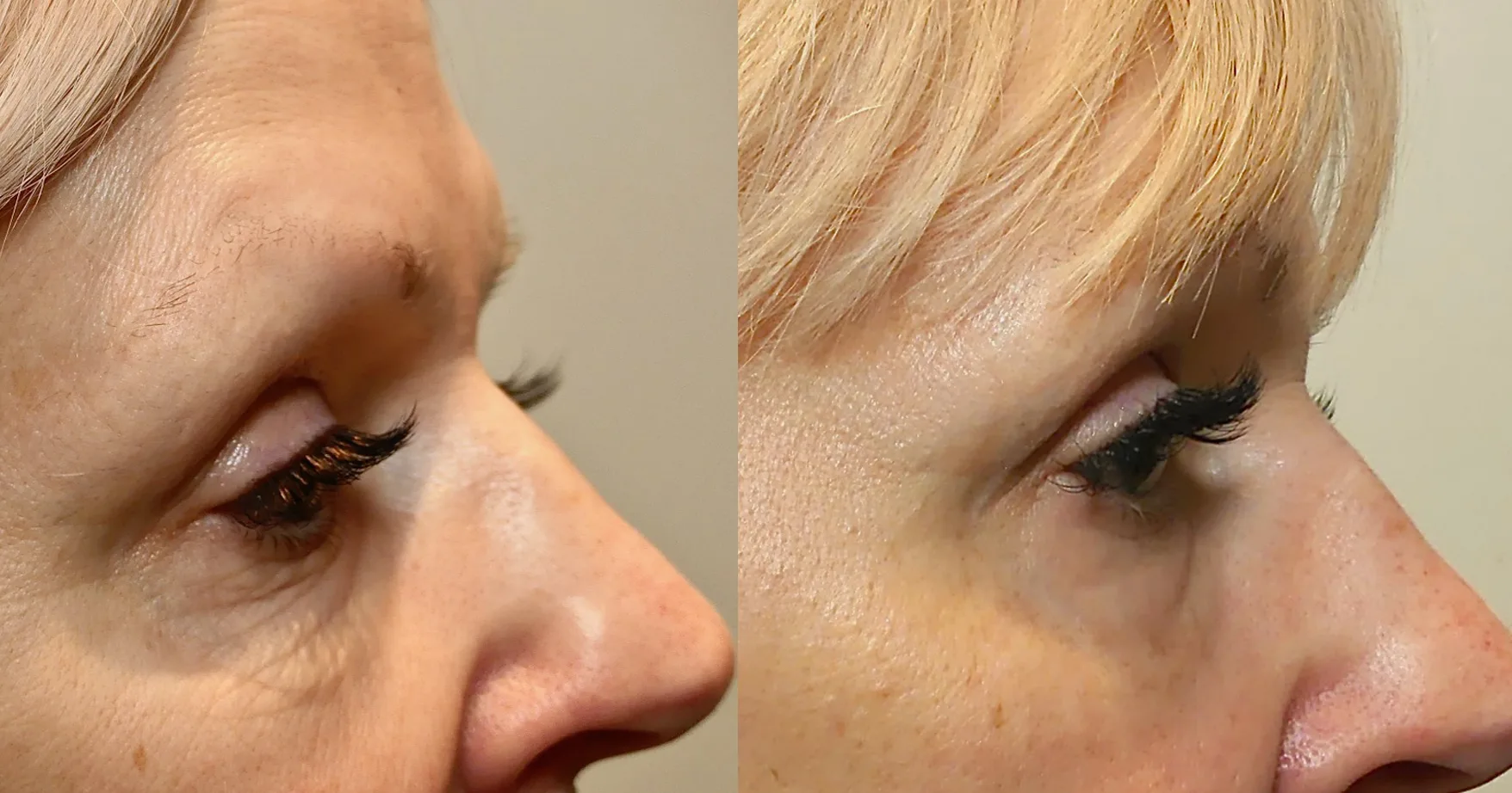 Morpheus8 Before and After Treatment in Baltimore 8