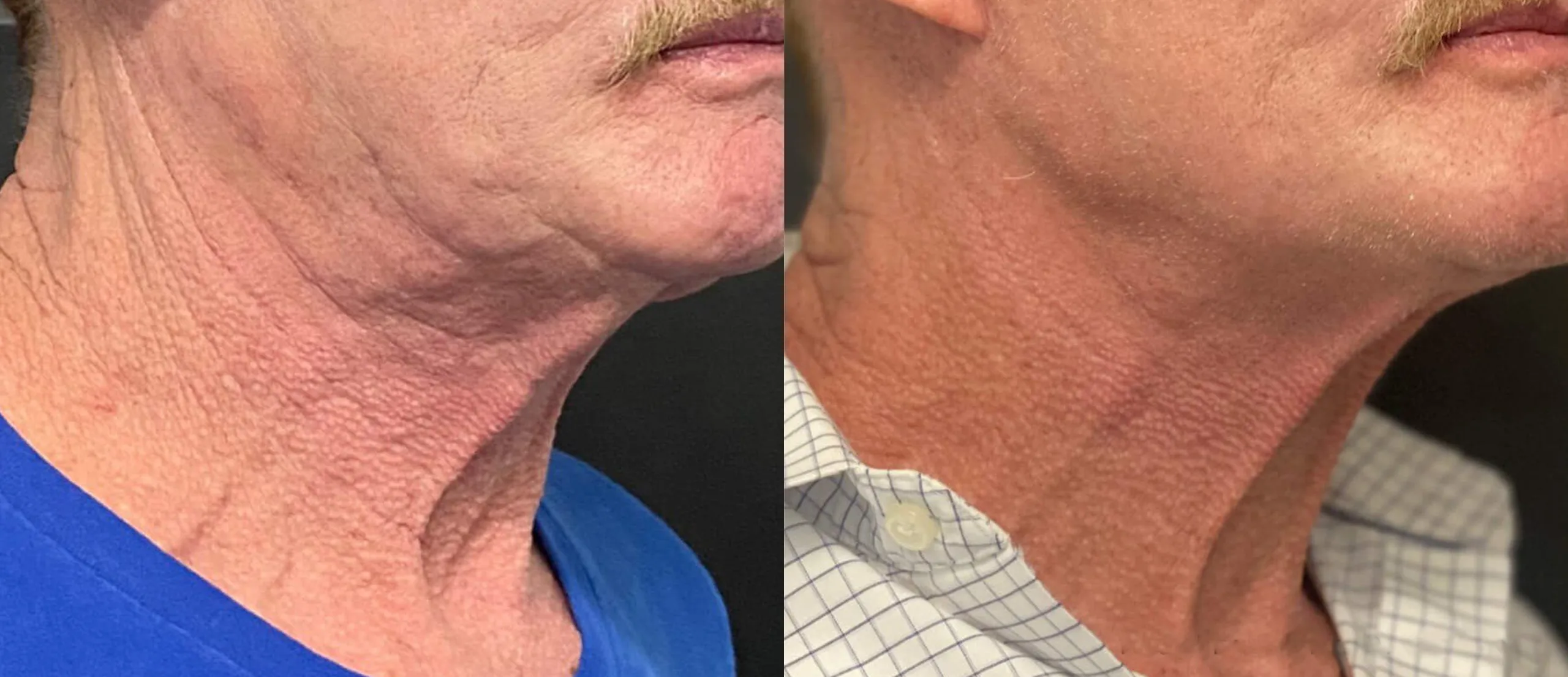 Morpheus8 Before and After Treatment in Baltimore 9